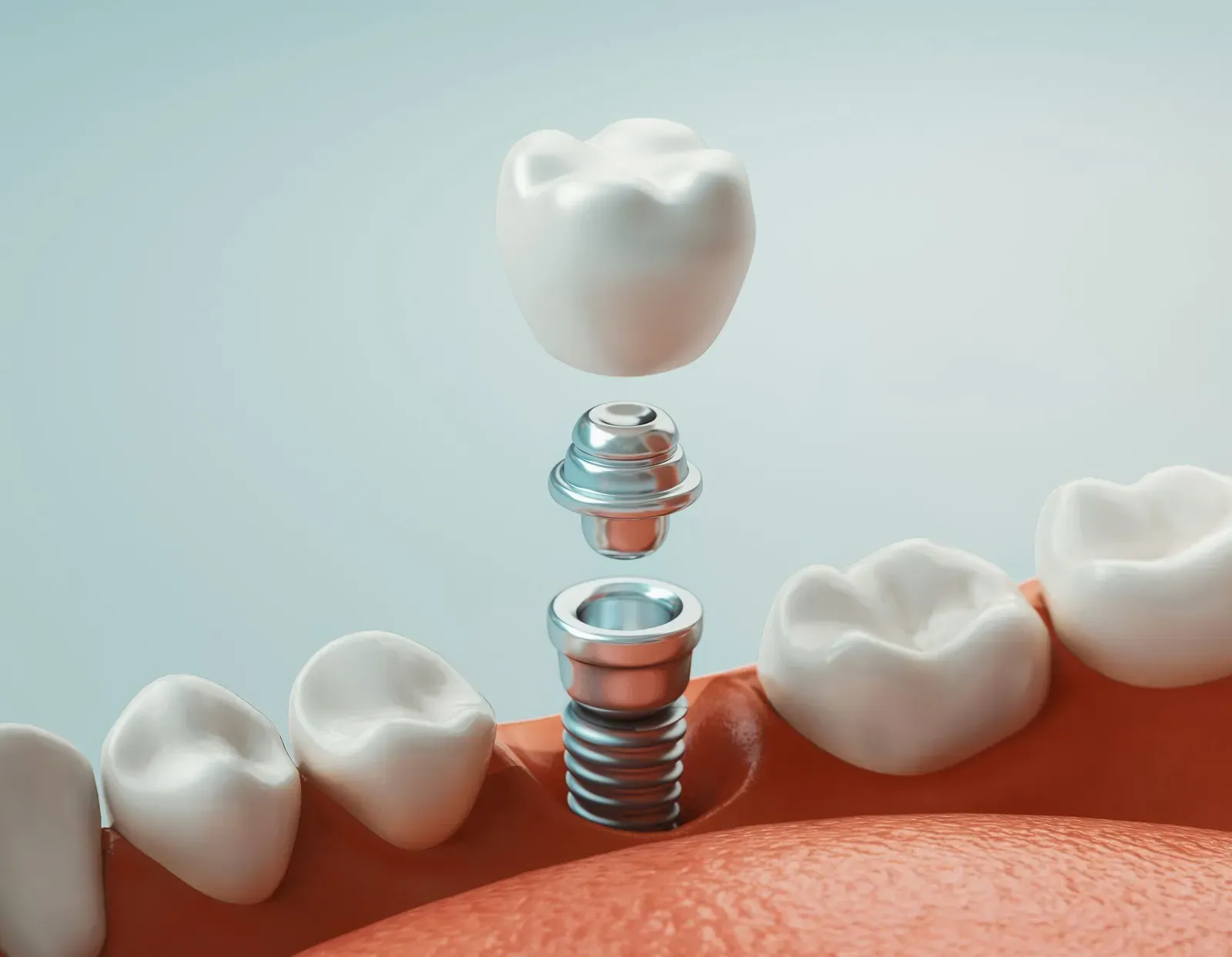 Single Tooth Vs. Full Arch Implants