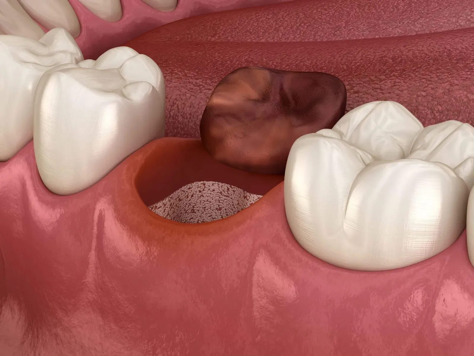 How to Avoid Dry Socket After a Tooth Extraction