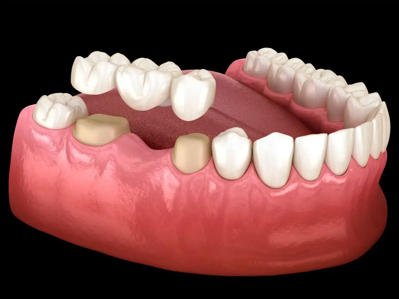 Pro Care for Dental Crowns at Urban Dental Studio