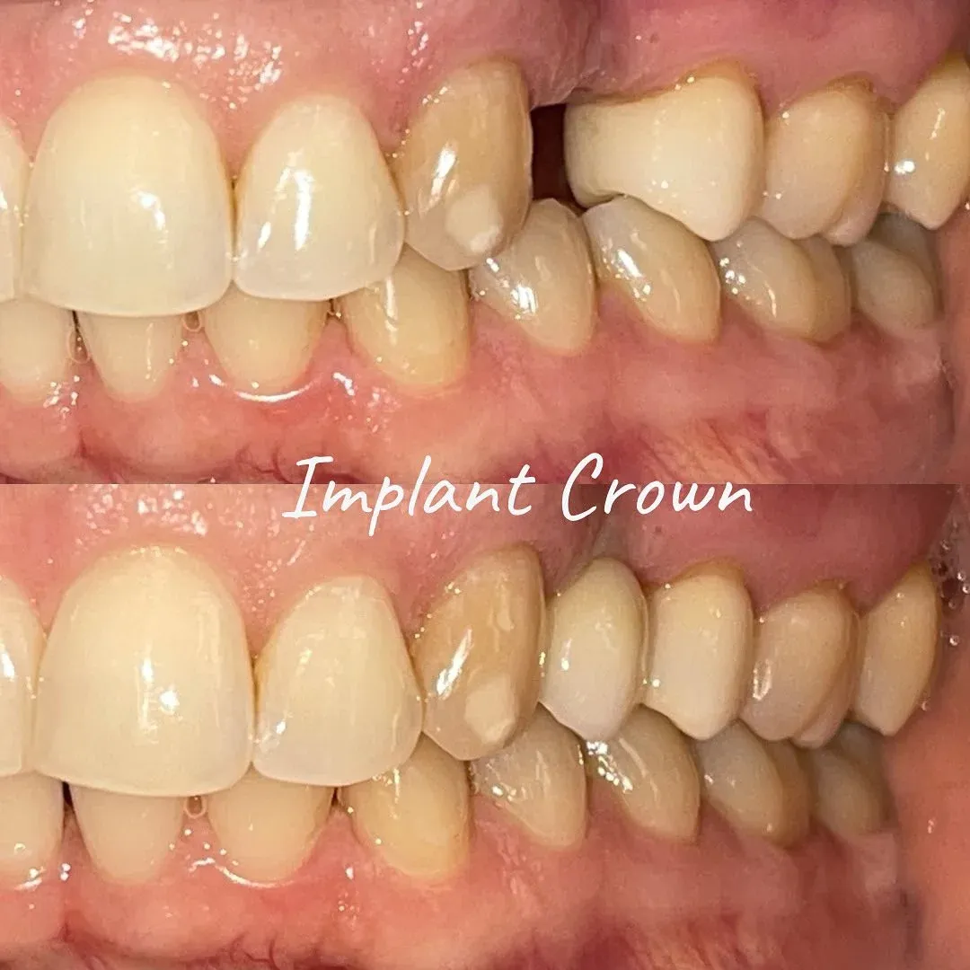 Implant crown before and after