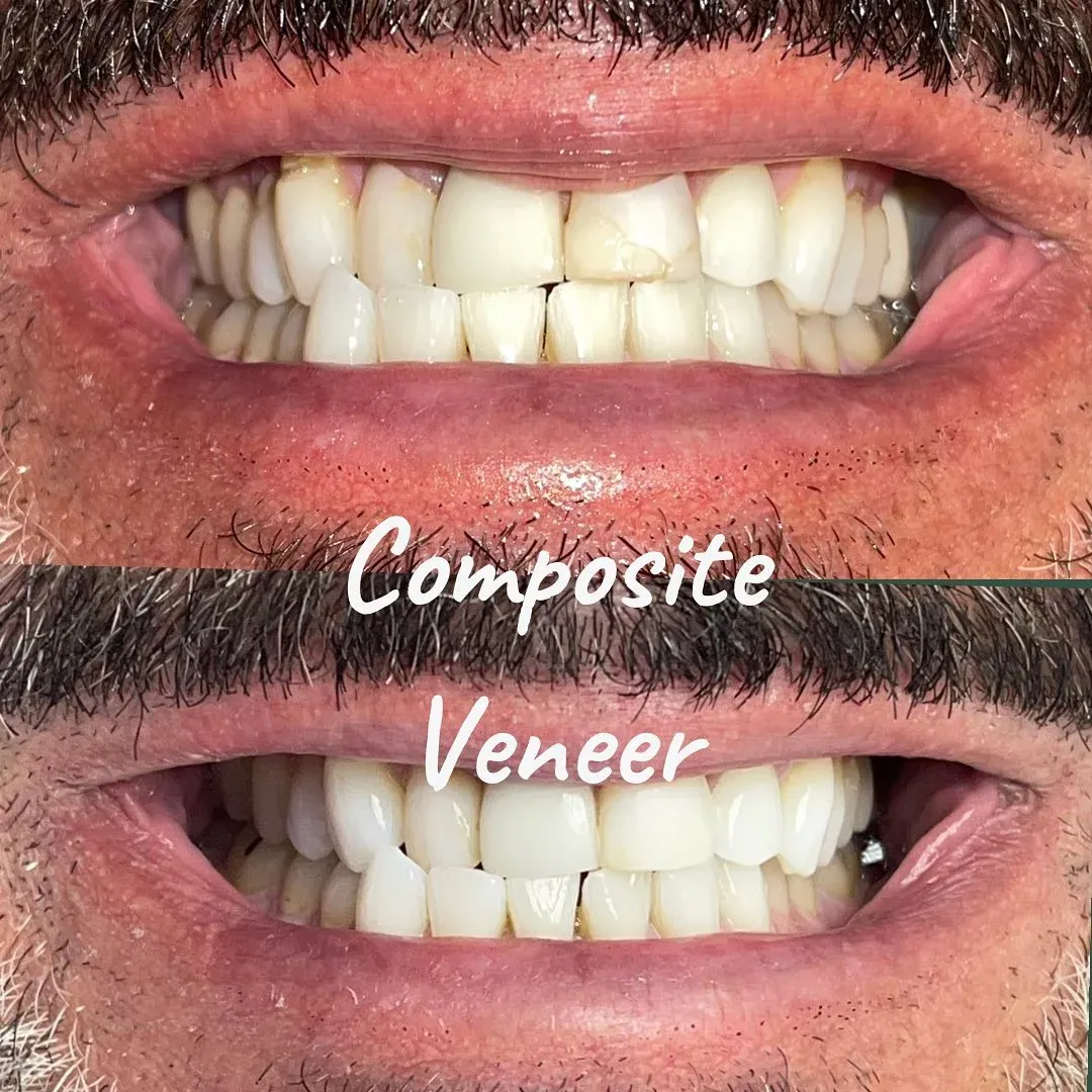 Smile transformation result