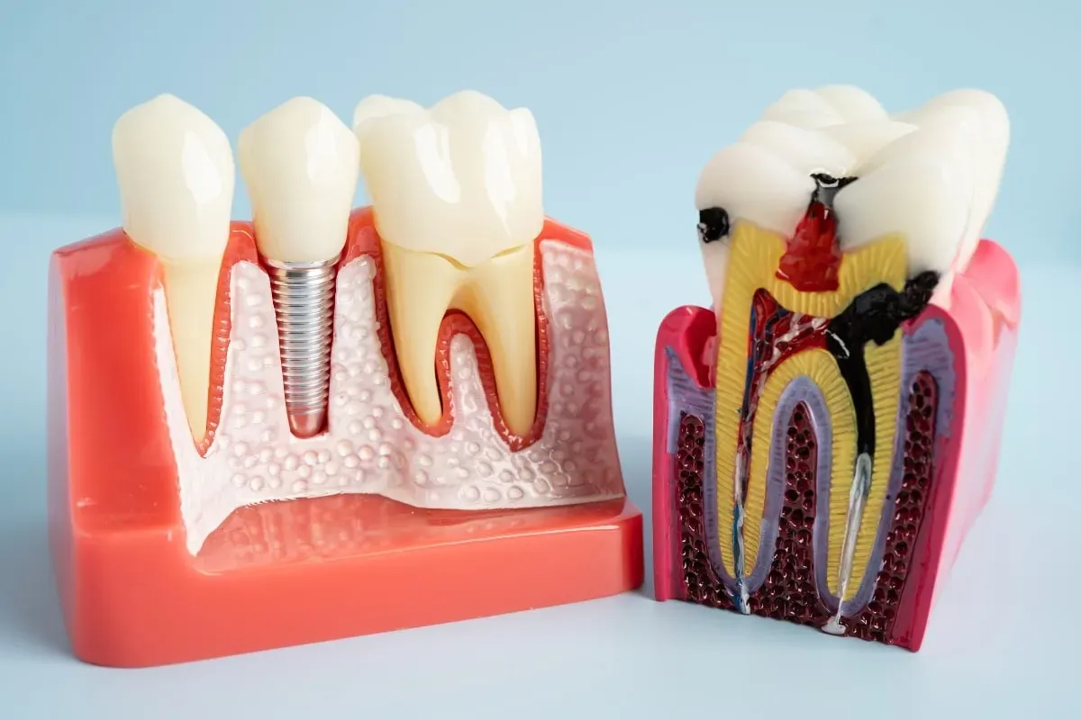 Oral Hygiene Tips to Keep Your Dental Implants Healthy