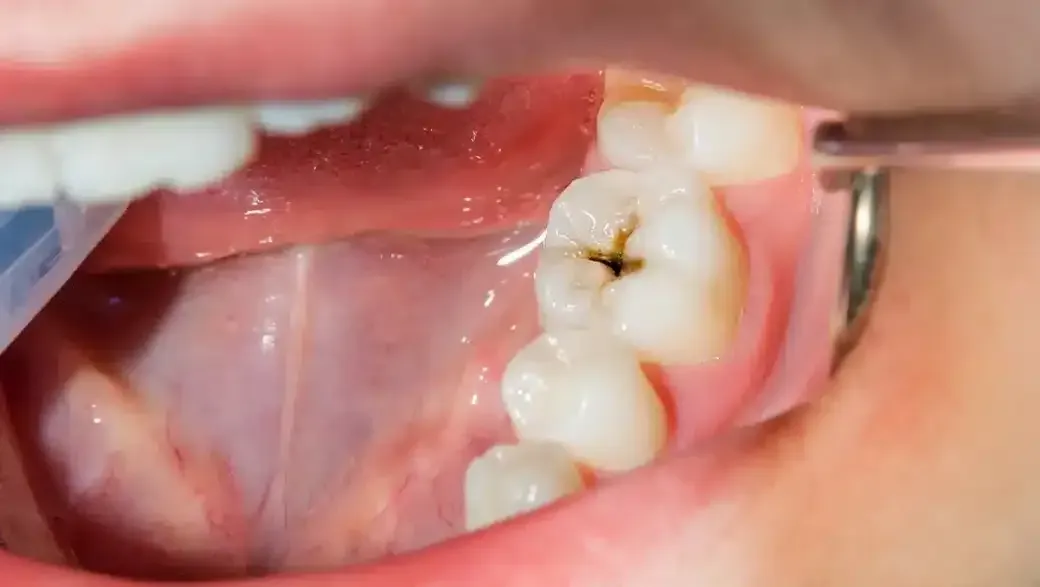 Are Cavities Contagious? How Tooth Decay Spreads