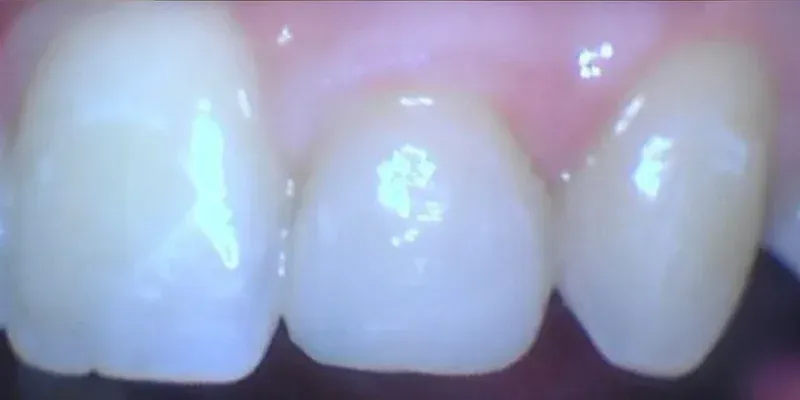 Dental Bondings