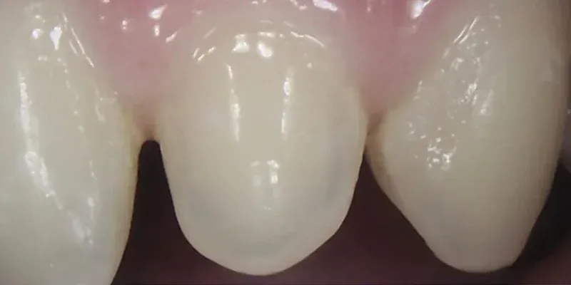 Dental Bondings