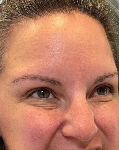 Botox