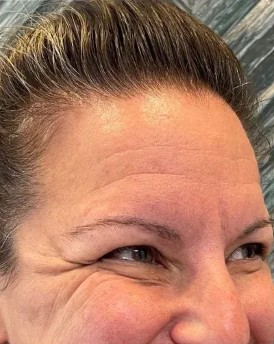 Botox
