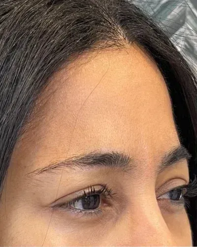 Botox Cosmetic