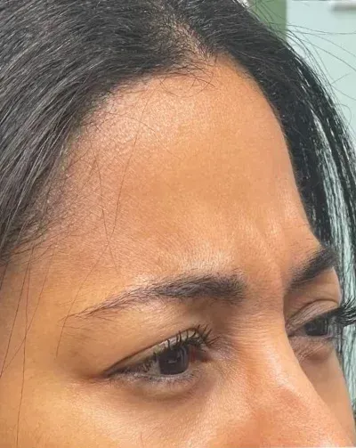 Botox Cosmetic
