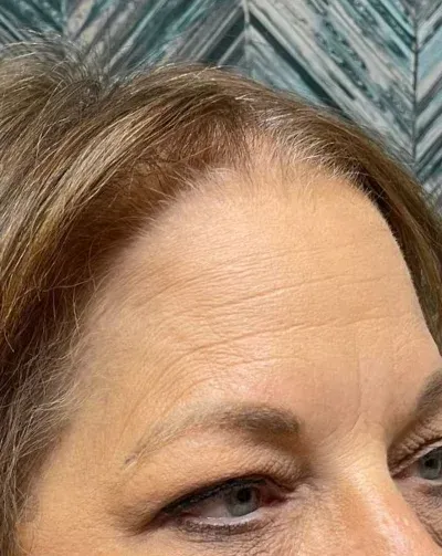 Botox Treatment