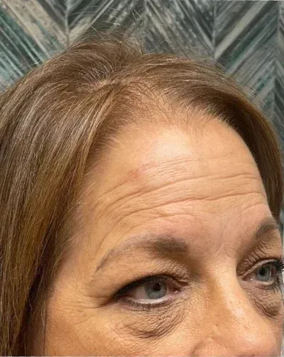 Botox Treatment