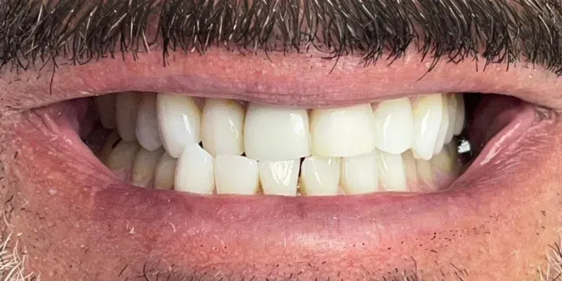 composite veneers