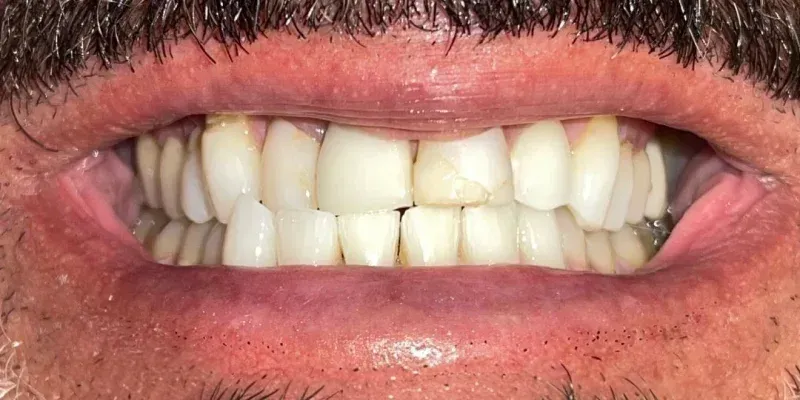 composite veneers