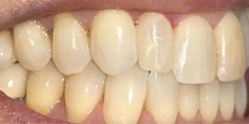 Dental Bondings