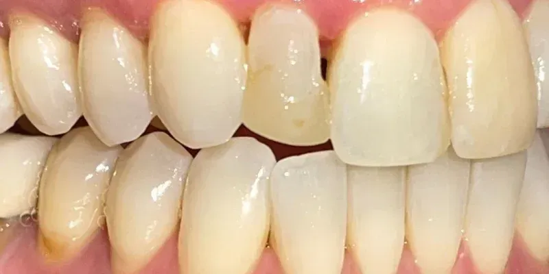 Dental Bondings