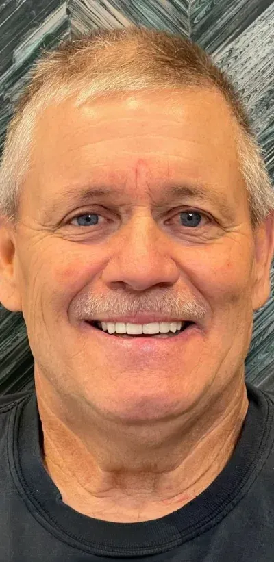 Full Mouth Rehabilitation