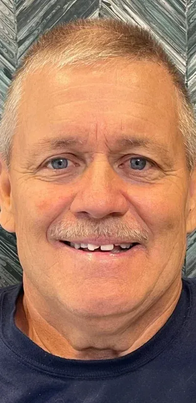 Full Mouth Rehabilitation