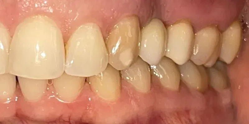 Dental Crowns