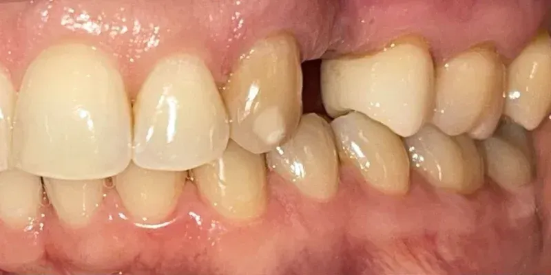 Dental Crowns