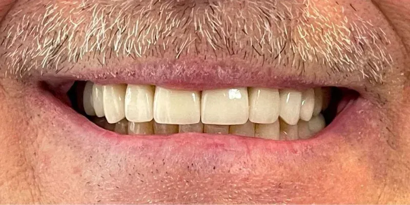 Porcelain Crowns