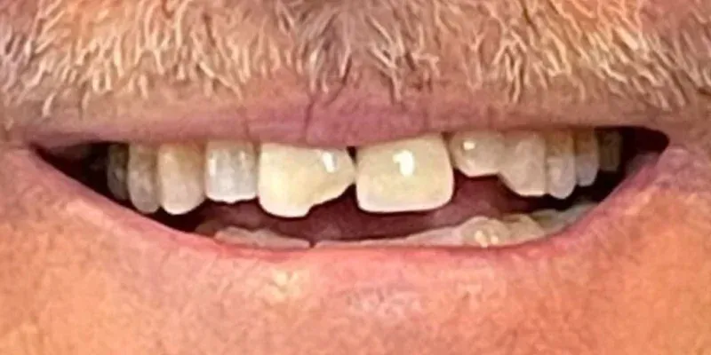 Porcelain Crowns