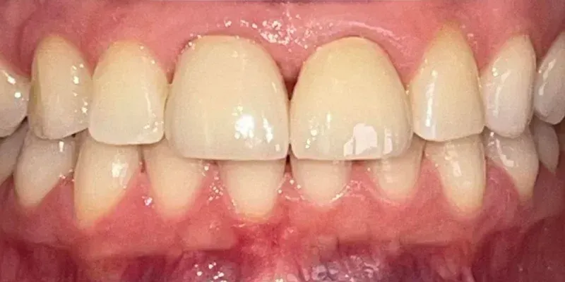 Porcelain Crowns