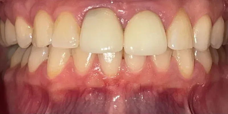 Porcelain Crowns