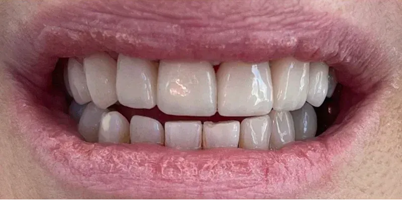 Porcelain Veneers