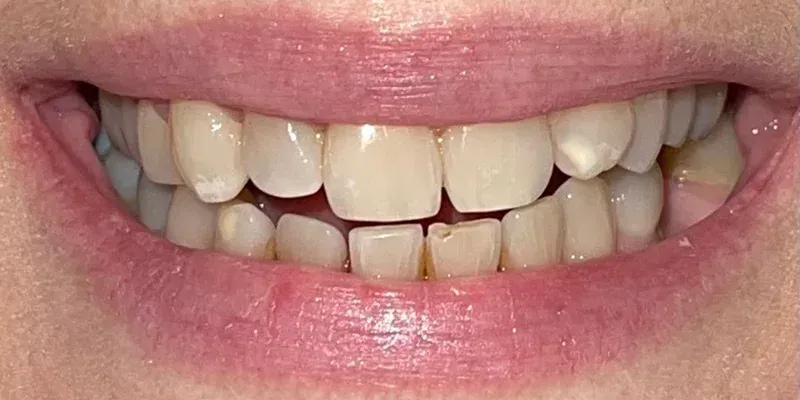 Porcelain Veneers