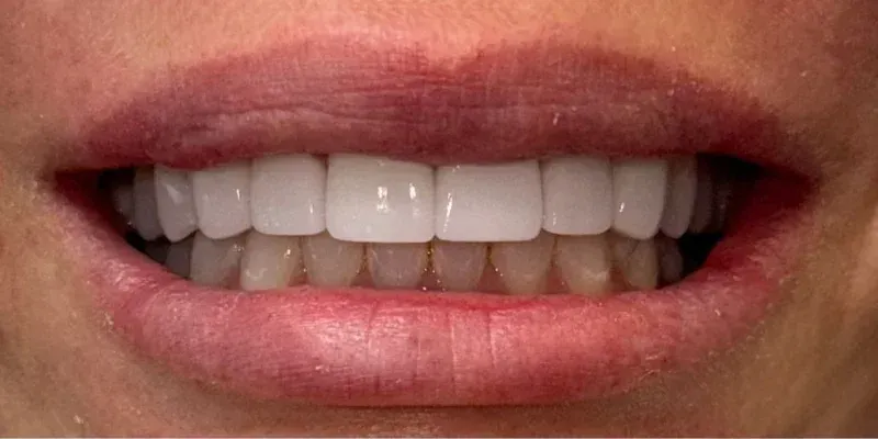 Porcelain Veneers