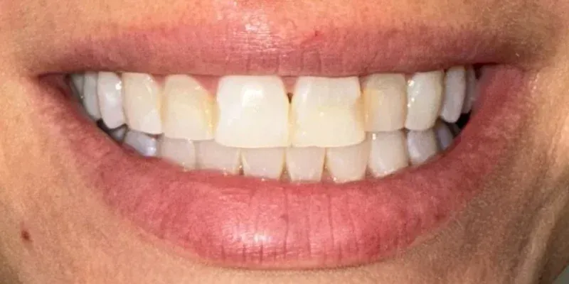 Porcelain Veneers