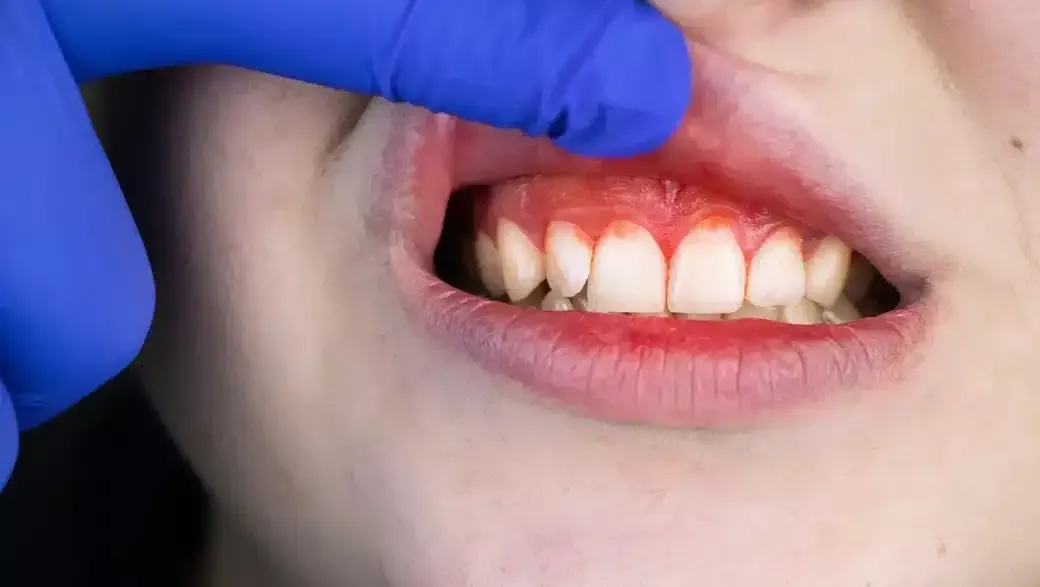 The First Signs of Periodontal Disease
