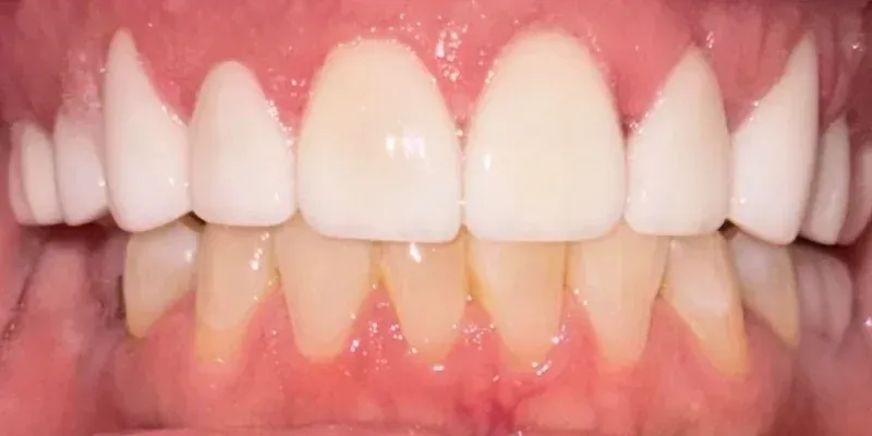 Veneers
