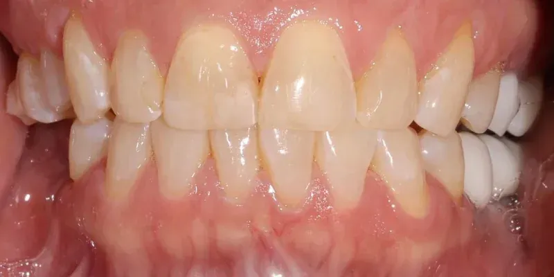 Veneers
