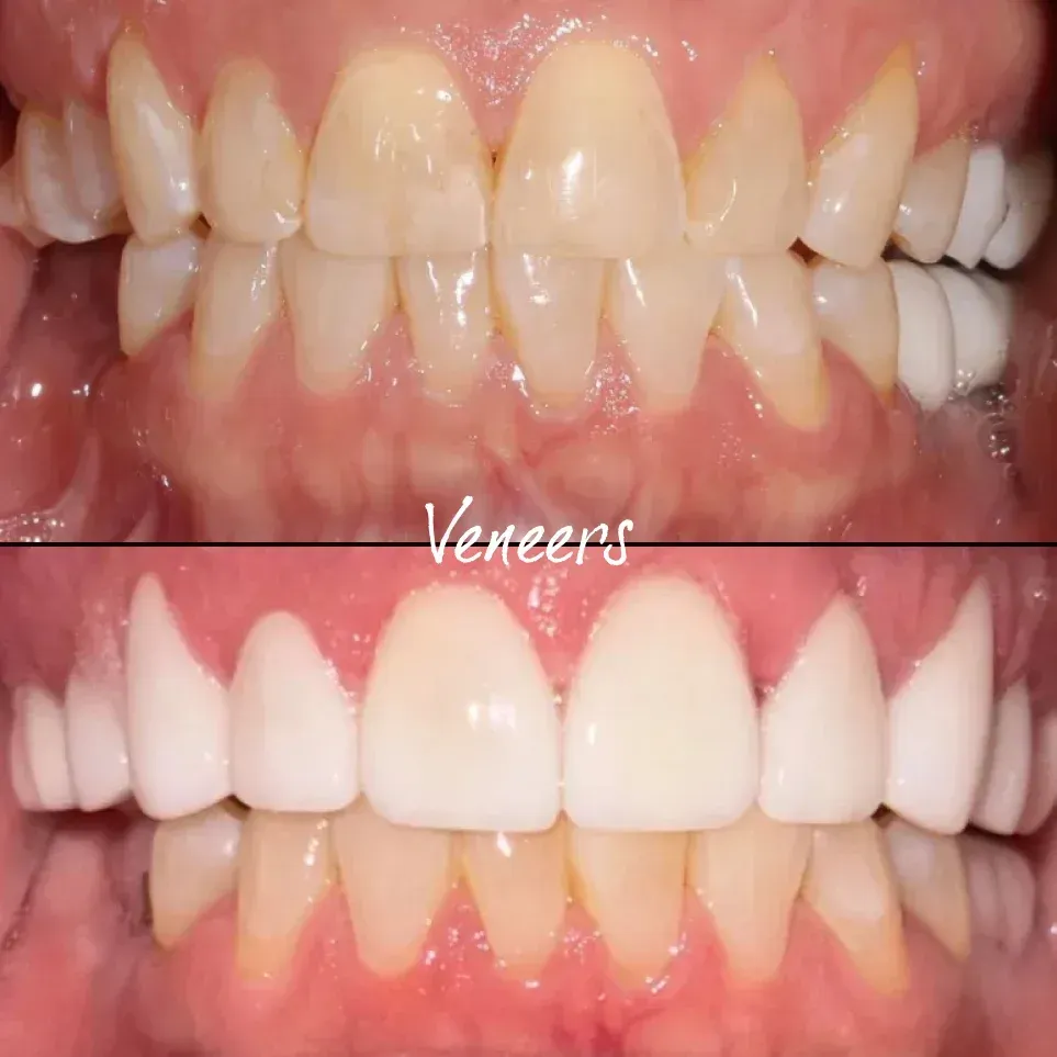 Smile transformation result