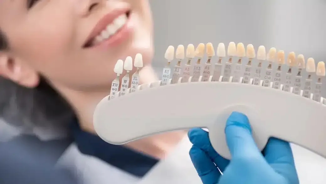 What Are Veneers? A Complete Guide to Dental Veneers
