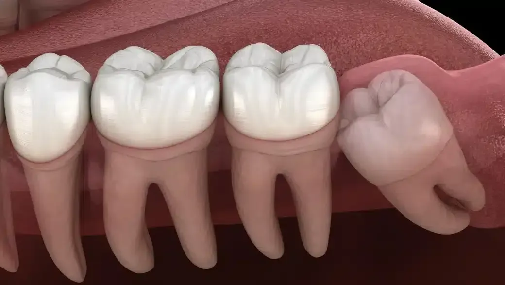 What to Expect 72 Hours After Wisdom Tooth Extraction