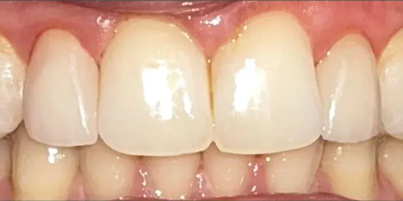 Whitening & Veneers