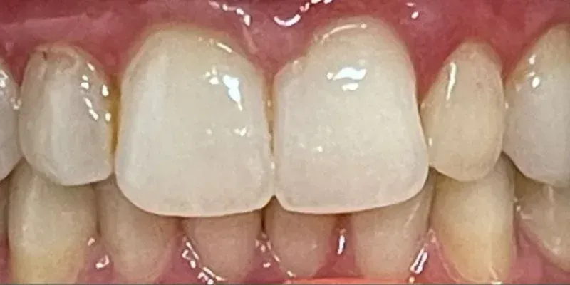 Whitening & Veneers