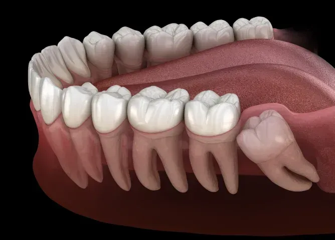 Photo related to wisdom teeth extractions