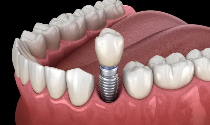 Smoking and Dental Implants: What You Need to Know