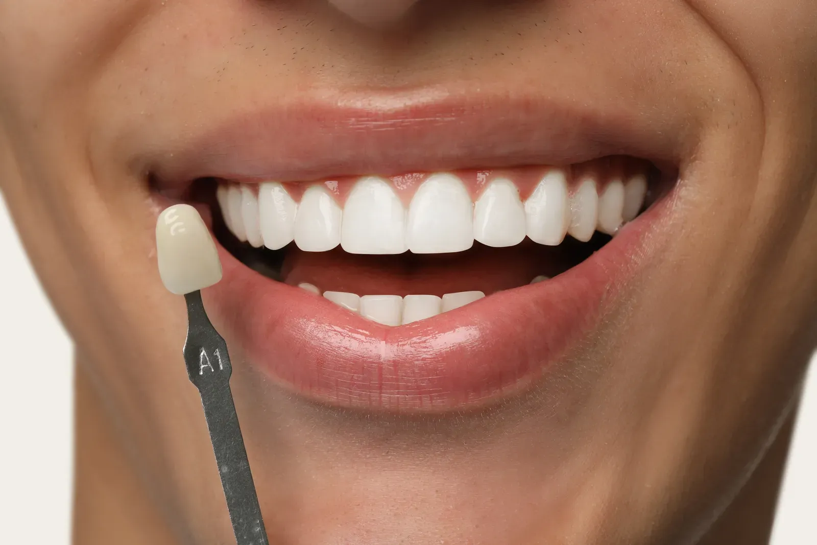 Veneers
